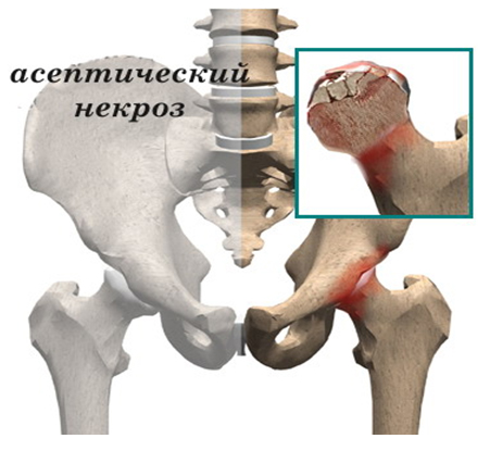 semne inițiale de artroză a articulației șoldului