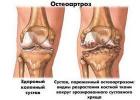 बड़े पैर की अंगुली के जोड़ में दर्द का कारण और उपचार