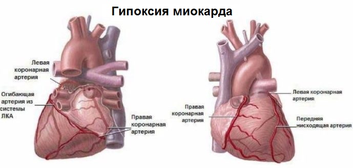 Гипоксия сердца медицинский термин