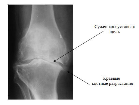 indometacină cu artroză a genunchiului