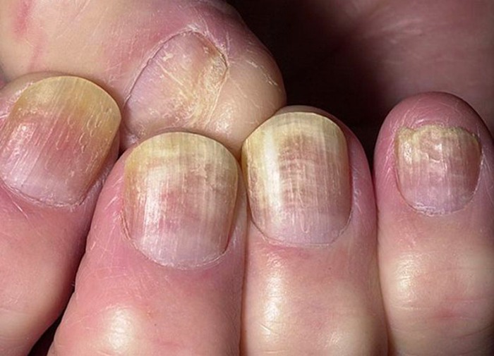 ciuperca unghiilor dimetil ftalat tratament