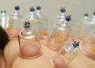 Hijama bleeding.  What is hijama?  What are its health benefits?  What parts of the body are suitable for bloodletting and the scheme of points