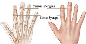 آرتروز انگشتان: علائم و درمان، علل، شرح کامل بیماری علائم آرتروز انگشتان دست