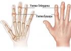 Артроз пальцев рук: симптомы и лечение, причины, полное описание заболевания Артроз пальцев рук симптомы