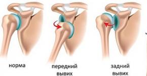 Dislokacija ramena - zdravljenje brez operacije doma